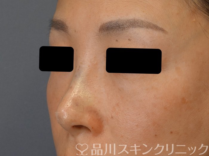 症例NO.74630のAFTER写真