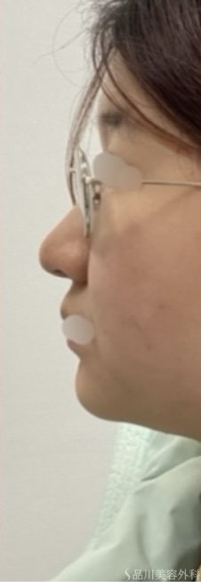 症例NO.72684のAFTER写真