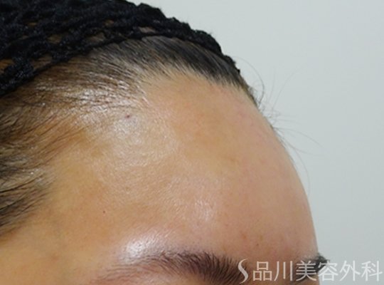 症例NO.72380のAFTER写真