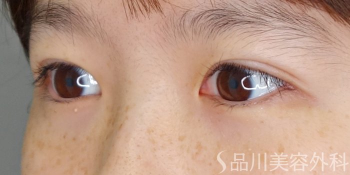 症例NO.70262のAFTER写真
