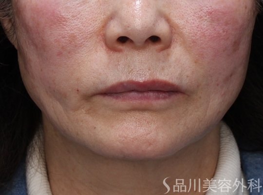 症例NO.73619のAFTER写真