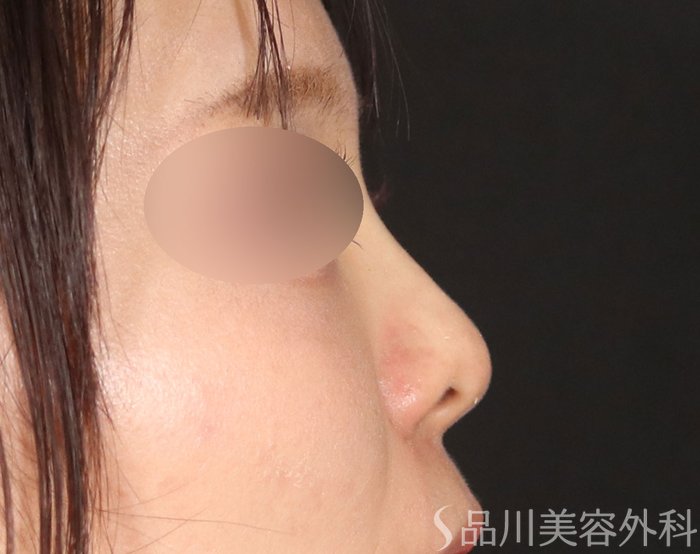 症例NO.72323のAFTER写真