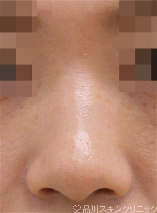 症例NO.42153のBEFORE写真