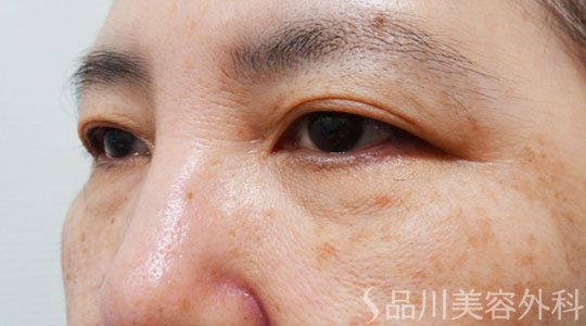 症例NO.69437のAFTER写真