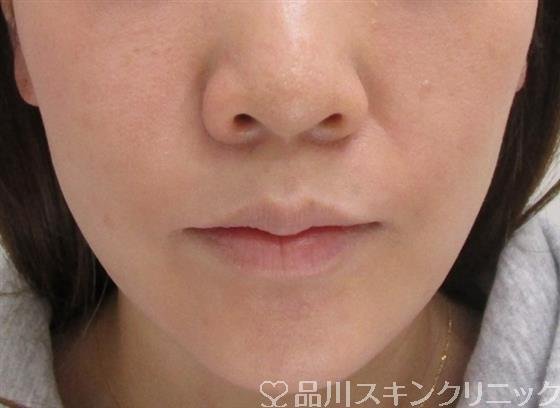 症例NO.39601のAFTER写真