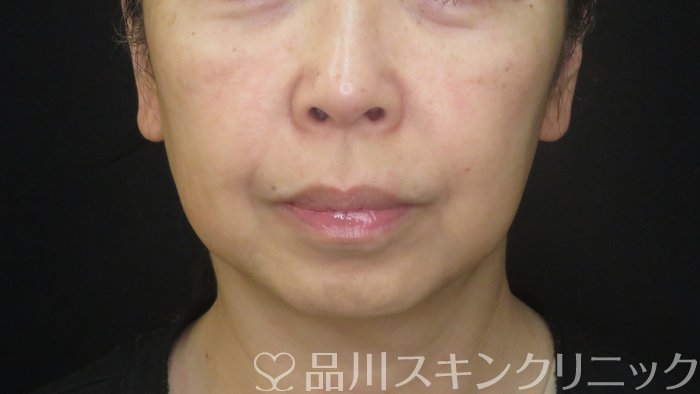 症例NO.72428のBEFORE写真