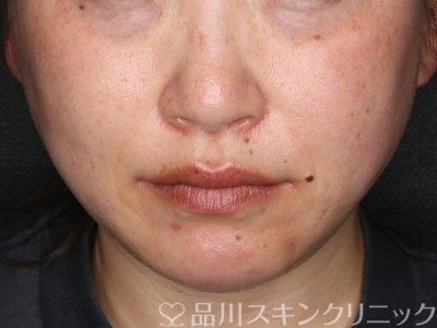 症例NO.75340のAFTER写真