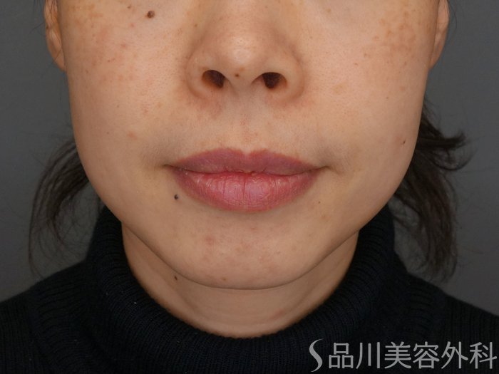 症例NO.72792のBEFORE写真