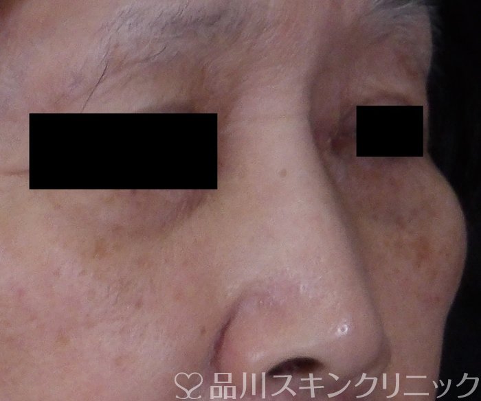 症例NO.70392のBEFORE写真