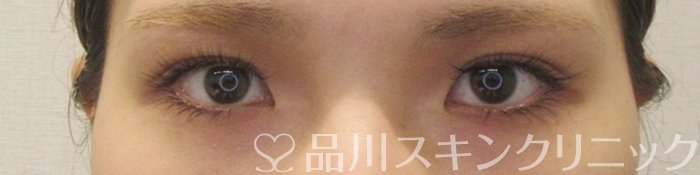 症例NO.70226のBEFORE写真
