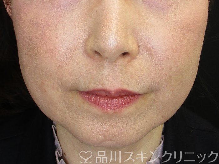 症例NO.73156のBEFORE写真