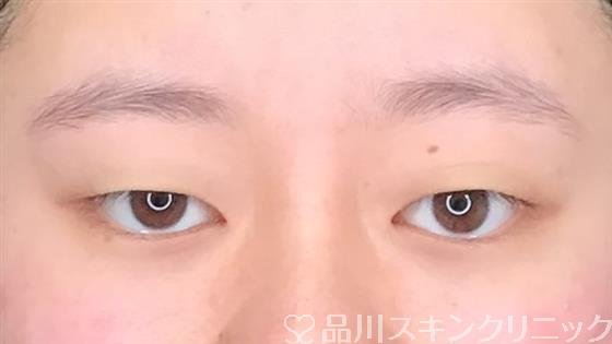 症例NO.60897のBEFORE写真