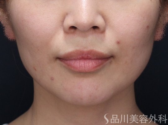 症例NO.73914のBEFORE写真