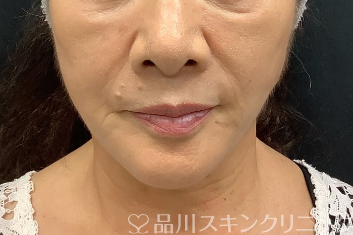 症例NO.69839のAFTER写真