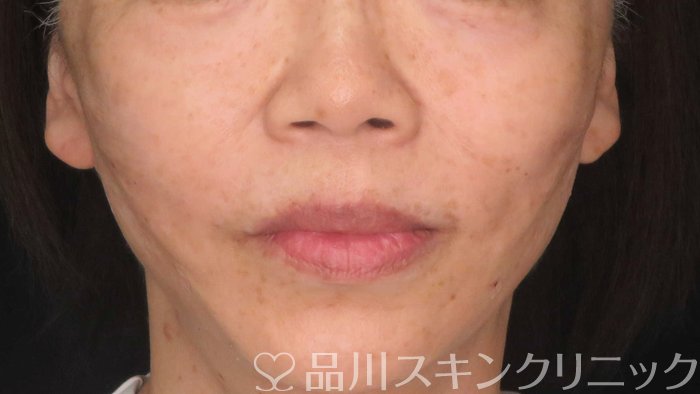 症例NO.71010のAFTER写真