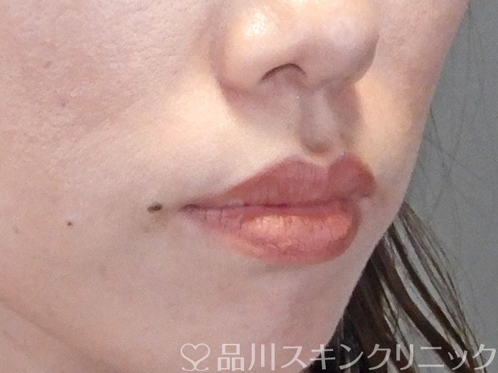 症例NO.65348のBEFORE写真
