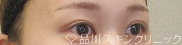 症例NO.73938のAFTER写真
