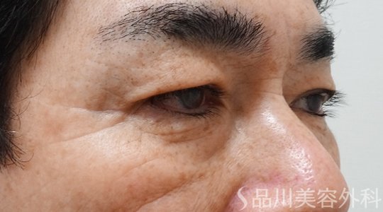 症例NO.69799のBEFORE写真