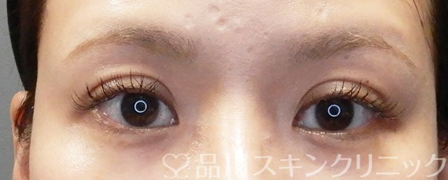 症例NO.72991のAFTER写真