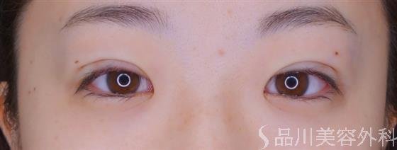 症例NO.51521のAFTER写真