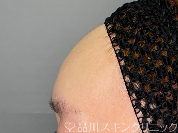 症例NO.70130のAFTER写真