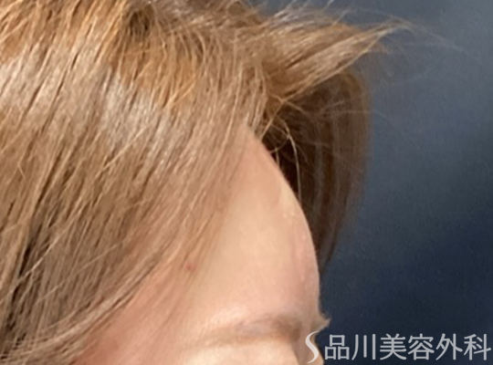 症例NO.74018のAFTER写真