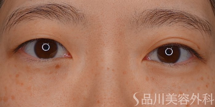 症例NO.73527のBEFORE写真