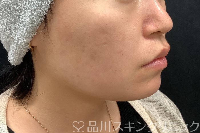 症例NO.69513のBEFORE写真