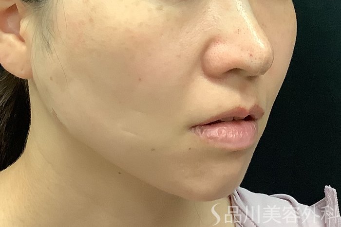 症例NO.71250のAFTER写真