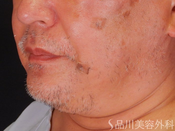 症例NO.69854のBEFORE写真