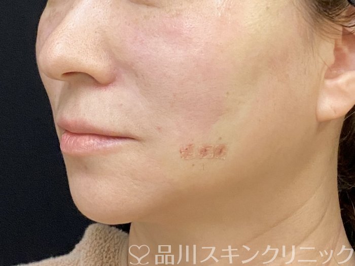 症例NO.74852のAFTER写真