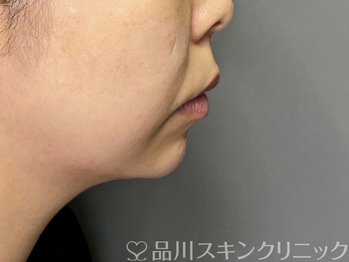 症例NO.65120のAFTER写真