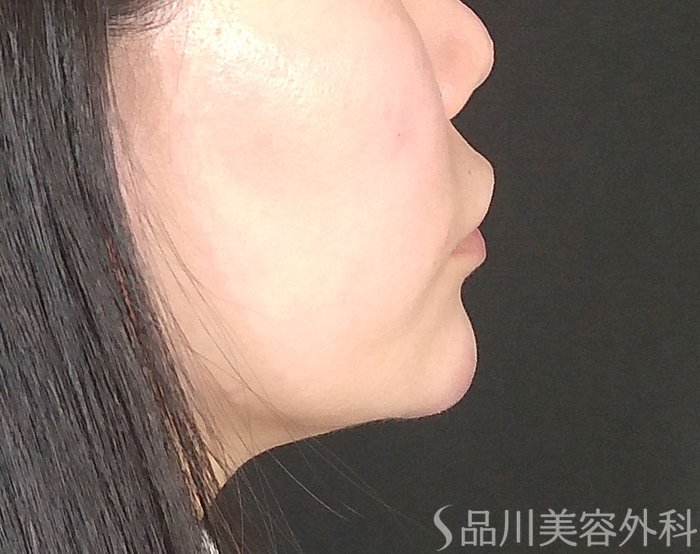症例NO.67837のAFTER写真