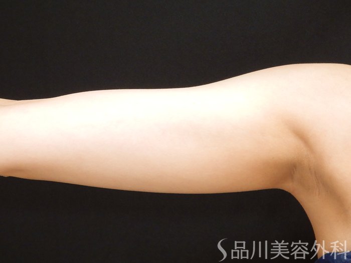 症例NO.70851のBEFORE写真