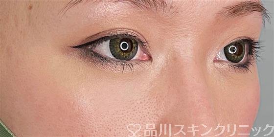 症例NO.55646のAFTER写真