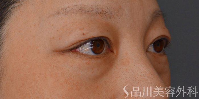 症例NO.73725のBEFORE写真