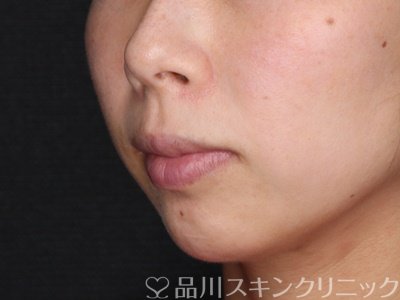 症例NO.71342のBEFORE写真