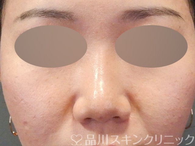 症例NO.64721のAFTER写真