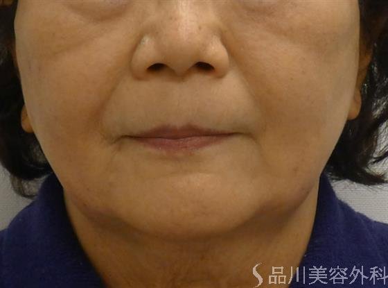 症例NO.33756のAFTER写真