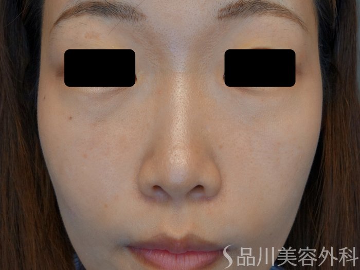 症例NO.74012のBEFORE写真