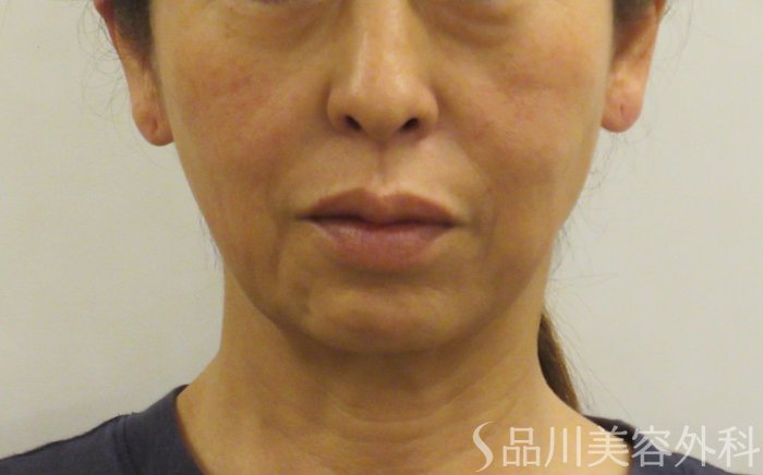 症例NO.71805のBEFORE写真