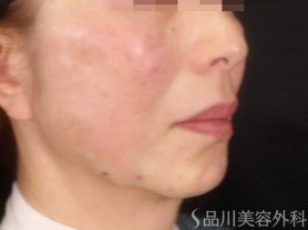 症例NO.73531のAFTER写真