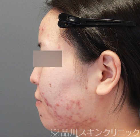 症例NO.70456のBEFORE写真