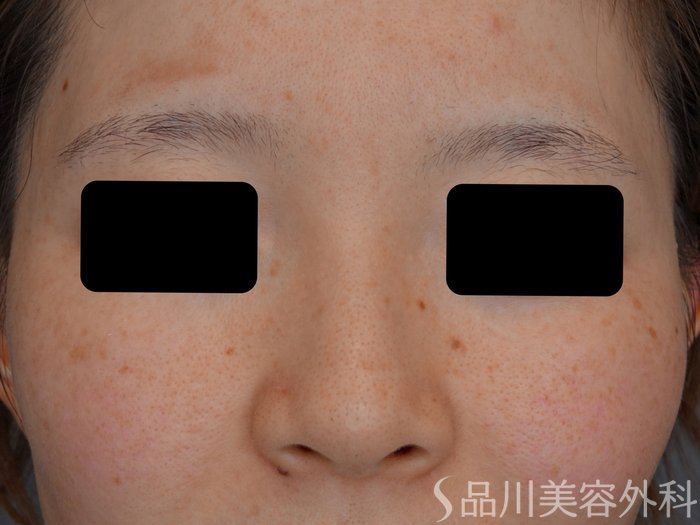 症例NO.74616のBEFORE写真