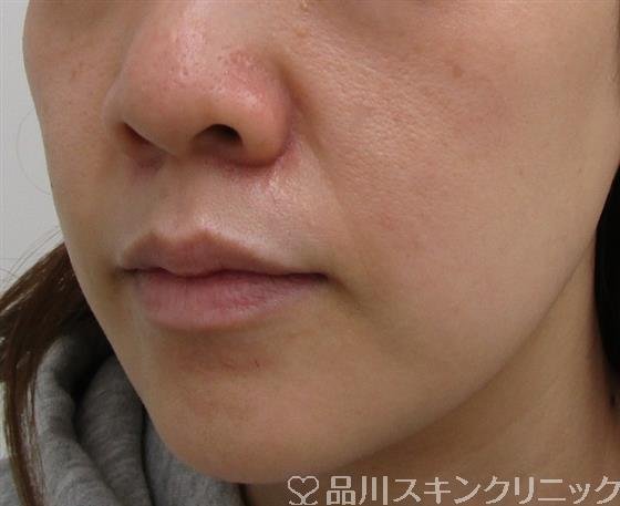 症例NO.39601のBEFORE写真