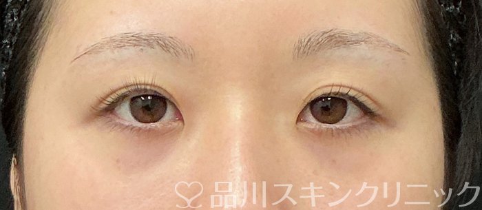 症例NO.74267のBEFORE写真