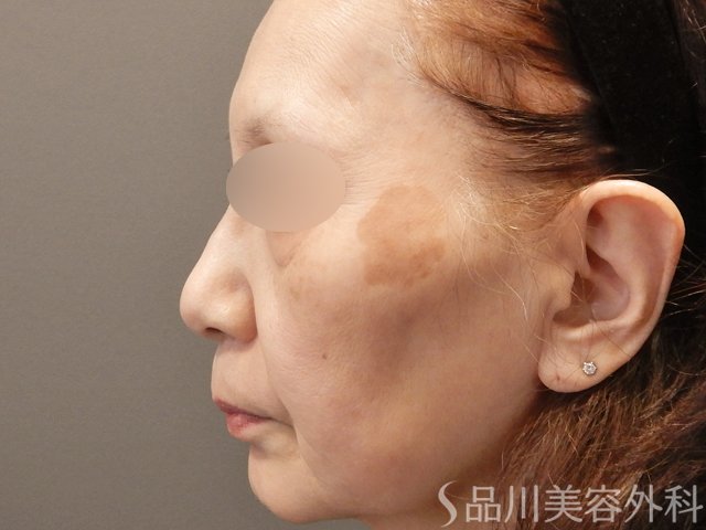 症例NO.74542のBEFORE写真