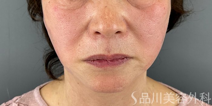 症例NO.72447のAFTER写真