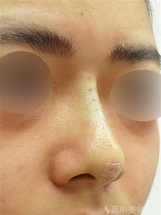 症例NO.42650のAFTER写真