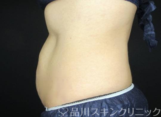 症例NO.74932のAFTER写真